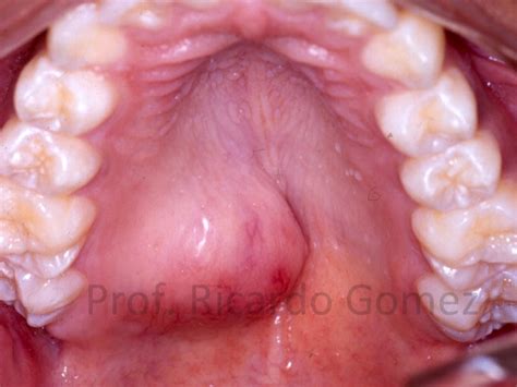 Una volta che un grumo viene rilevato che è pensato per essere adenoma pleomorfo, una biopsia viene eseguita per determinare s. cirugia buco maxilo facial: adenoma pleomorfo en paladar y ...