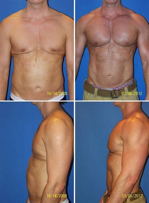 We did not find results for: Male Pectoral Implants Before & After Photos | Dr. G ...