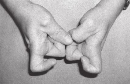 A patient with jersey finger may present with pain and swelling to the volar (the palmar) aspect of the dip joint and the finger will be extended at rest. Flexor_Digitorum_Profondus - Anatomicum
