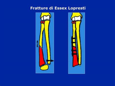 PPT - Fratture avambraccio PowerPoint Presentation, free ...