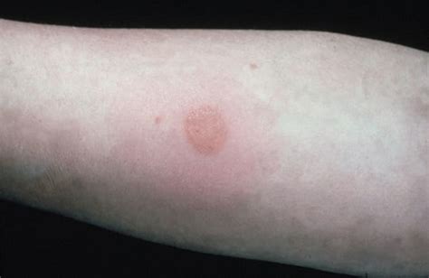 Positive tb skin test versus allergic reaction these. Папула Манту: что это такое, норма у детей, почему нет ...