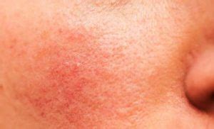 Jenis cleanser serta manfaatnya yang disesuaikan dengan jenis kulit (foto: 5 Jenis Penyakit Kulit serta Cara Pengobatannya ...