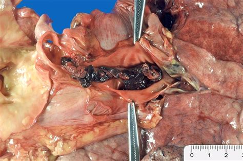 Presenza di versamento pleurico monolaterale di grado moderato che non giustificava la rapidità di insorgenza del. Frische zentrale Lungenembolie - DocCheck Pictures