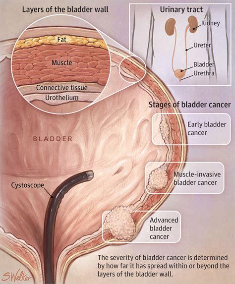 For bladder cancer, the stage is determined based on examining the sample removed during a turbt (see diagnosis) and finding out whether the cancer has spread to other parts of this type of bladder cancer often comes back after treatment, usually as another noninvasive cancer in the bladder. Bladder Cancer | Oncology | JAMA | The JAMA Network