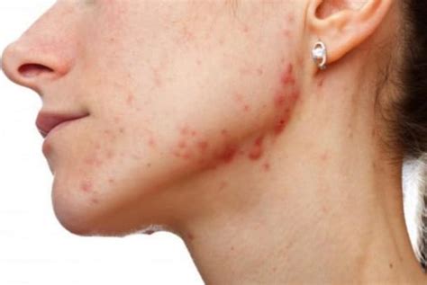 See full list on wikihow.com How To Get Rid Of Pimple/Acne Scabs Fast On Face: 36 Home ...