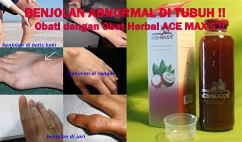 Hal pertama yang bisa anda lakukan untuk mengecilkan betis kaki adalah mencoba untuk berjalan dengan benar. Obat Herbal Benjolan di Betis Kaki atau Tangan Terampuh ...