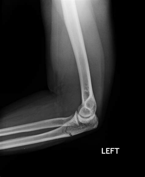 Common Elbow Injuries - My Family Physio