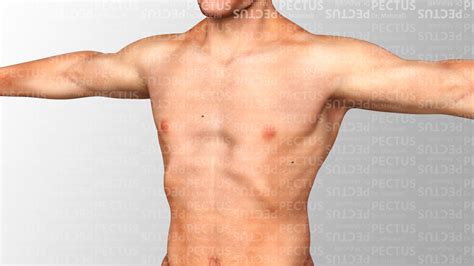 Learn all about pectus carinatum ( pigeon chest).pectus carinatum symptoms , treatments and cuses.you will find everything about carinatum chest. Cirurgia do Pectus Excavatum | Pectus - Dr. Malucelli