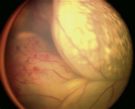 Leukocoria resembles eyeshine, but leukocoria can occur in humans and other animals that lack eyeshine because their retina lacks a tapetum lucidum. Retinoblastoma | Ento Key