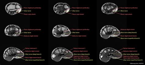 Muscle anatomy thigh mri muscle anatomy thigh mri, thigh muscle anatomy axial mri, thigh muscle anatomy on mri, human muscles. Roentgen Ray Reader: February 2012