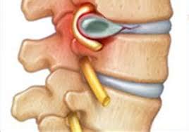 Luckily, there are ways you can find relief both sitting and sleeping. Sciatica Fix Without Surgery (Herniated Disc) Part 1 | Capital Physiotherapy