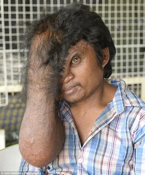 Contact your health care provider if you have sudden hair loss. Cambodian man with a huge growth covering half his face ...