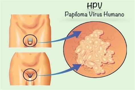 Jugendliche, die bis zum alter von 15 jahren noch nicht gegen hpv geimpft worden sind, sollten die impfung möglichst bald und noch vor dem 18. Gardasil Erfahrungen, Bewertungen und Nebenwirkungen ...