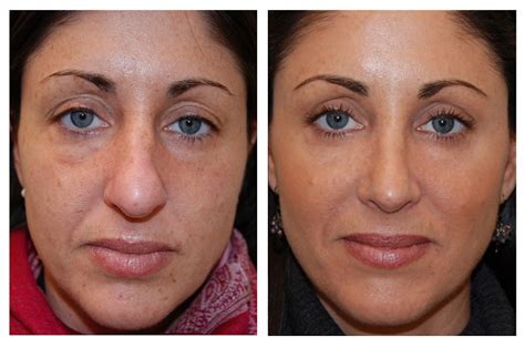 On other complexions, such as fair skin with light hair, or in laser hair removal for brown skin, the laser heated the surrounding skin too much, causing burns. Before and After | Renova Laser Hair Removal & MedSpa ...