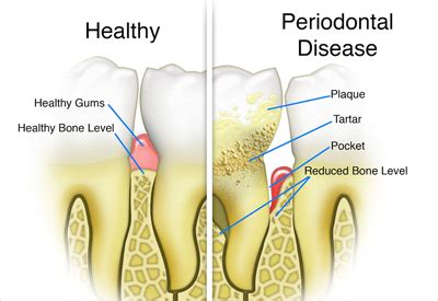 The splayed teeth were uncomfortable to eat with, had periodic bouts of acute infections (abscess), and had become unsightly. Laser Gum Surgery in Nashville, TN - Tooth & Bone Loss