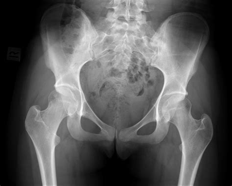 Labeled ap pelvis xray anatomy male anatomy radiology pelvis. Acetabular protrusio and pelvic tilt | Image | Radiopaedia.org