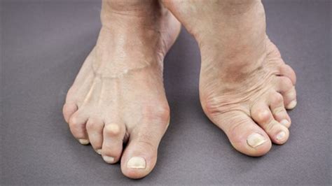 Maybe you would like to learn more about one of these? Hallux Rigidus: A Degenerative Toe Arthritis - Women Fitness
