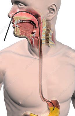 Nasogastric intubation is a medical process involving the insertion of a plastic tube (nasogastric tube or ng tube) through the nose, past the throat, and down into the stomach. Nasogastric tube - Stock Image - C008/2310 - Science Photo ...