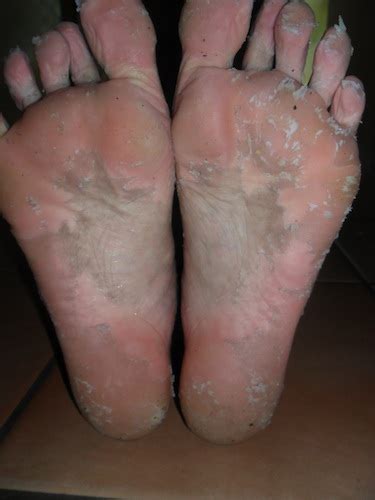 If your cabinets are stained, use a 220 sandpaper. Dead Skin Acid Peel for your feet. (Kitchen Cabinet Remedy!)