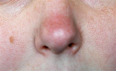 Responding to comments on how to stop a runny nose, get rid of a runny nose and runny nose medicine or remedies. How To Get Rid Of Your Big Nose In Selfies