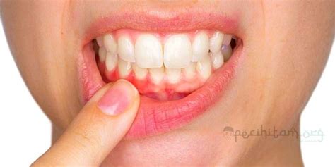 Terakhir, cara untuk mencegah adanya gusi berdarah bisa dengan mengunjungi dokter gigi. Apakah Gusi Berdarah Dapat Membatalkan Wudhu? Berikut ...