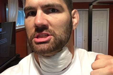 I just wanna let my fans know as many details as possible about what happened to me because i want them involved. Chris Weidman Underwent 'Unexpected Surgery' On Wednesday