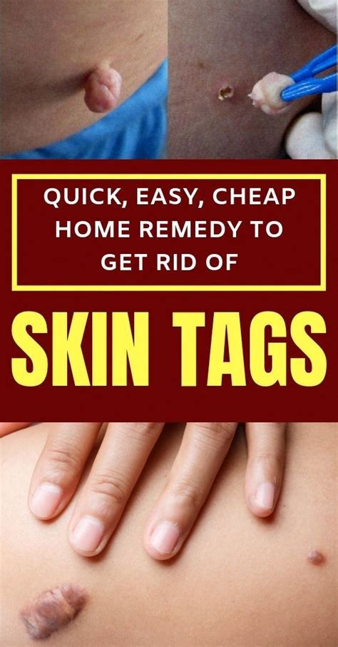 How to remove skin tags naturally? Skin Tags remove naturally | Skin tag, Home remedies for ...
