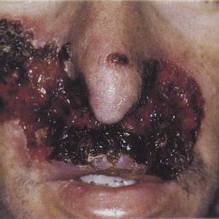 People hear the word herpes and automatically freak out. Phagedenic herpes on the face of an HIV-infected patient ...