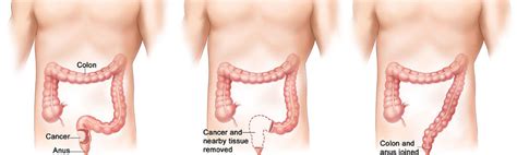 This week's whatnexter of the week is buckey shelby. Colon Cancer can be Defeated with Minimally Invasive ...
