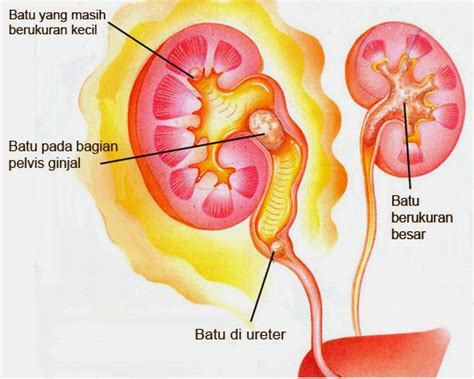 Maybe you would like to learn more about one of these? Obat Herbal Ke 14: Obat Tradisional Untuk Penghancur Batu ...