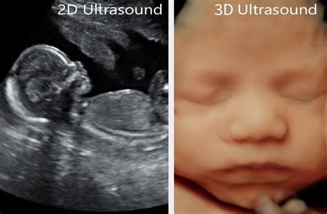 Ultrasound therapy insurance by industry experts. 3D Ultrasounds Columbus GA - OBGYN Specialists of Columbus, GA