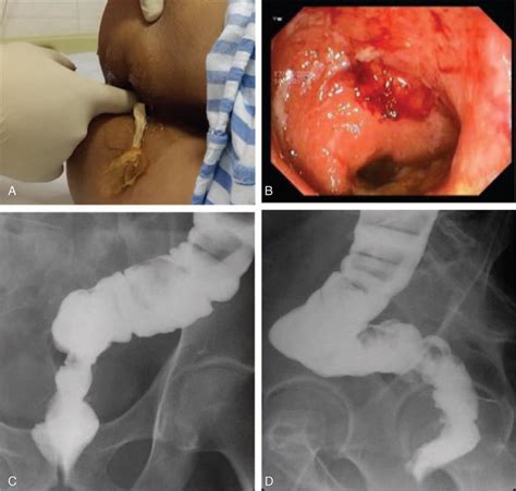 Un adicional perineo de examen rectal está incluido. Methods for assessing BAR loosening and anastomotic ...