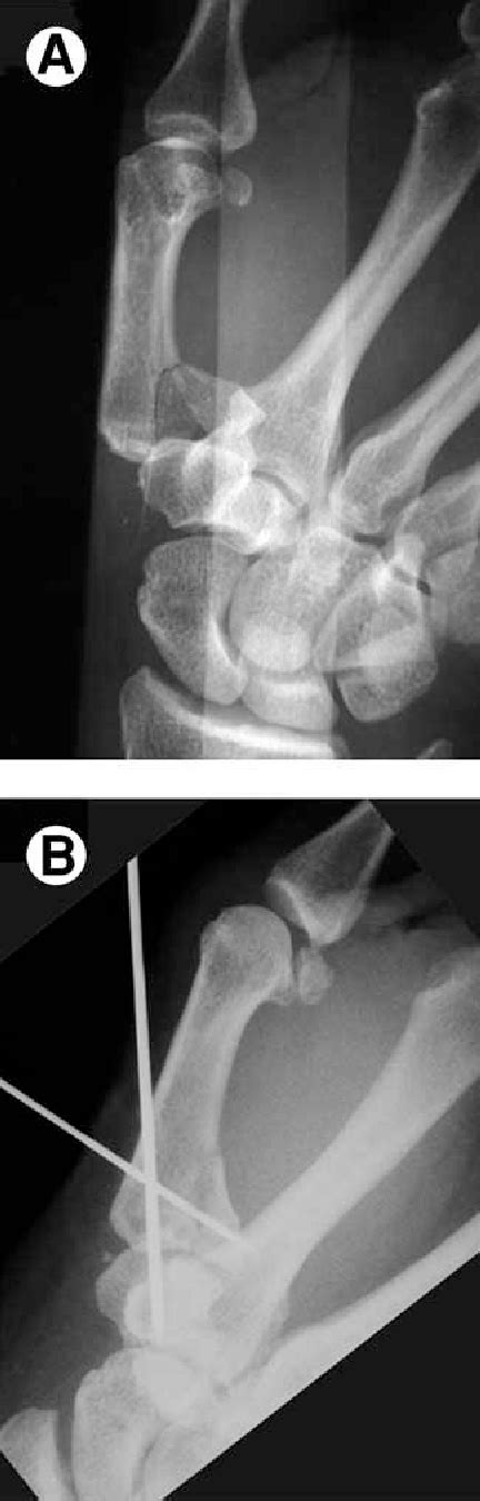 PDF METACARPAL FRACTURES | Semantic Scholar