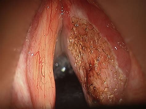 A cancerous (malignant) tumour is a group of cancer cells that can grow into and destroy nearby tissue. Queensland Voice Centre | Larynx and Throat Cancer