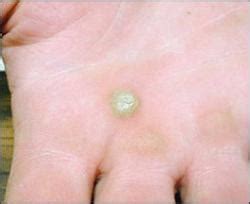 Common warts (verruca vulgaris) are benign epithelial proliferations associated with human topical vitamin a has been shown to be a successful treatment of common warts in prior informal studies. Il trattamento delle verruche recalcitranti con il Bacillo ...