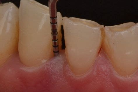 How can you reverse gum disease by yourself? Periodontal probing checks the depth of the gum pockets in ...