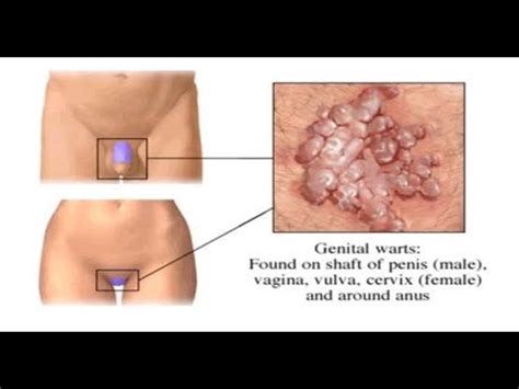 It's not a big deal unless you have parkinson's and a dull razor. How to Remove Genital Warts - Natural Cure for Genital ...