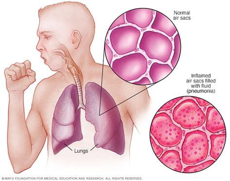 Edelman, md, ketua pegawai perubatan american lung association (ala). MY Health Venture: Rahsia Paru-paru Berair Sembuh Lebih ...