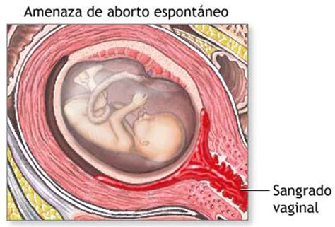 Generalmente pasa inadvertido y el feto sigue estando presente durante varias semanas, debido a la falta de síntomas. MEDICINA: ABORTO