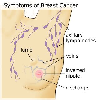 The exact cause of breast. goldman: Signs Of Breast Cancer