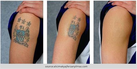 Laser tattoo removal is one way that these permanent designs are removed. Remove To Tattoo How Permanent