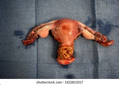 M.alibaba.com has found 3,324 images of in uterus for you. Hysterectomy Images, Stock Photos & Vectors | Shutterstock