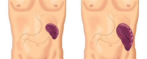 Complete information about enlarged spleen, including signs and symptoms; The Causes & Treatment Options For An Enlarged Spleen | Dr ...
