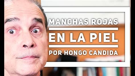 Tiña negra tiña negra tiña negra es un feohifomicosis superficial causada por el hongo productor de pigmentos hortaea wernicki. Episodio #1259 Manchas rojas en la piel por hongo cándida ...