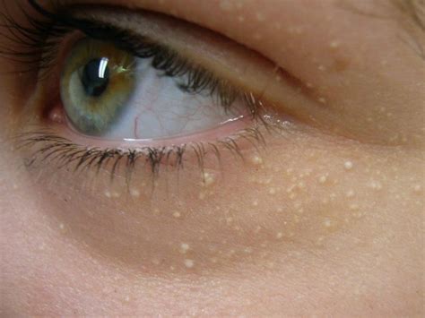 Cara Mengatasi Bruntusan Pada Bayi - Dunia Herbal