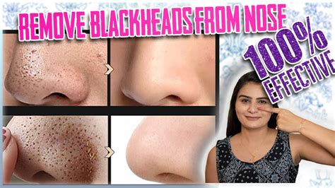 It is a mild remedy which suits all skin types and removes excess oil content from face. How To Remove Blackheads From Nose | Blackheads Remove At ...