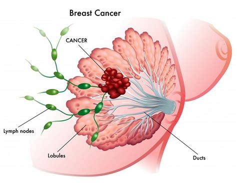 Cancer needs to be shown that you are the real deal. What Is Stage 3 Breast Cancer and How to Treat It? | Just ...