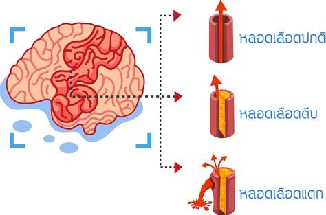 โรคหลอดเลือดสมอง หรือโรค อัมพฤกษ์ อัมพาต คือ ภาวะที่สมองขาดเลือดไปเลี้ยงทำให้เกิดอาการ ปากเบี้ยว พูดไม่. อัมพฤกษ์ อัมพาต จากโรคหลอดเลือดสมอง | โรงพยาบาลเปาโล ...