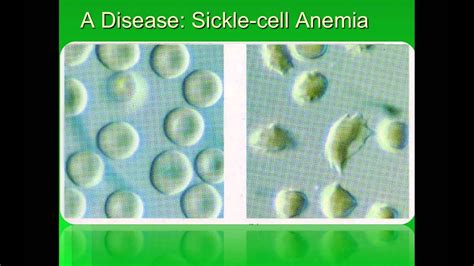 Sickle cell disease is a group of disorders that affects hemoglobin, the molecule in red blood cells that delivers oxygen to cells throughout the body. Gene Mutations and Sickle-cell Anemia (IB Biology) - YouTube