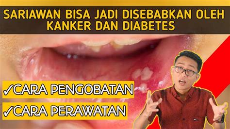 Bintik putih/bercak atau area yang luas selalu dianggap sebagai kondisi lembab dan disebut candida atau sariawan. CARA MENGOBATI SARIAWAN DENGAN OBAT MEDIS DAN CARA ...